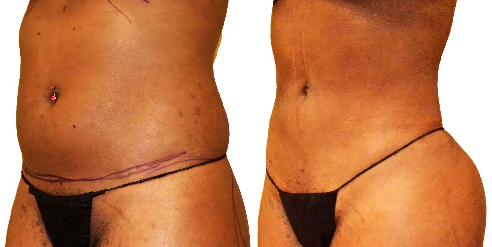 Before/After Lipo 360 before and after, actual patient of Dr. Long