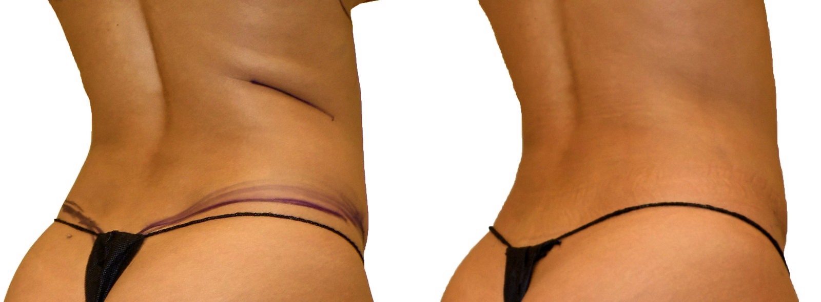 Before/After Lipo 360 before and after, actual patient of Dr. Long