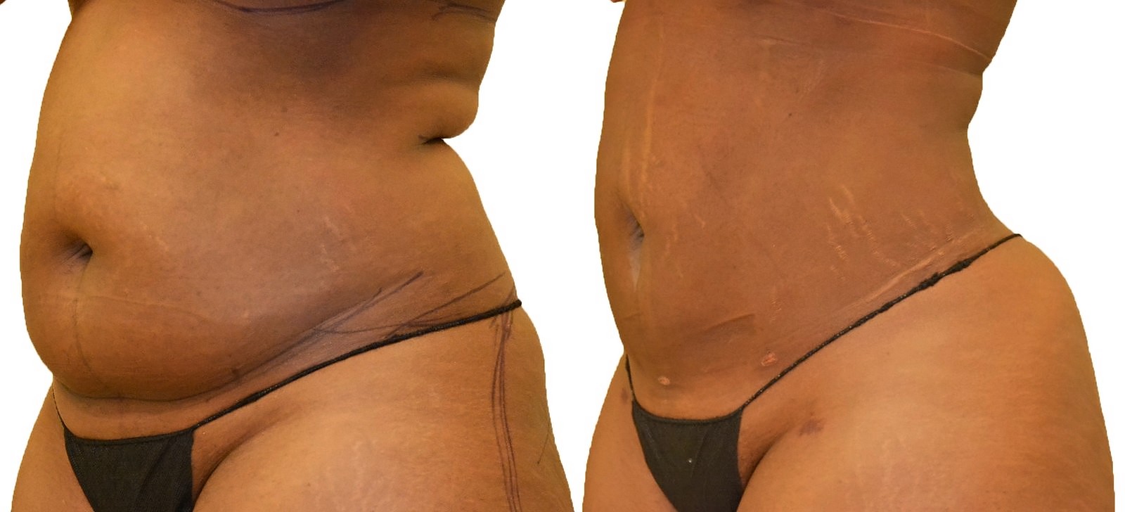 Before/After Lipo 360 before and after, actual patient of Dr. Long