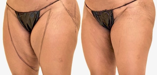 Before/After Thigh liposuction before and after, actual patient of Dr. Long