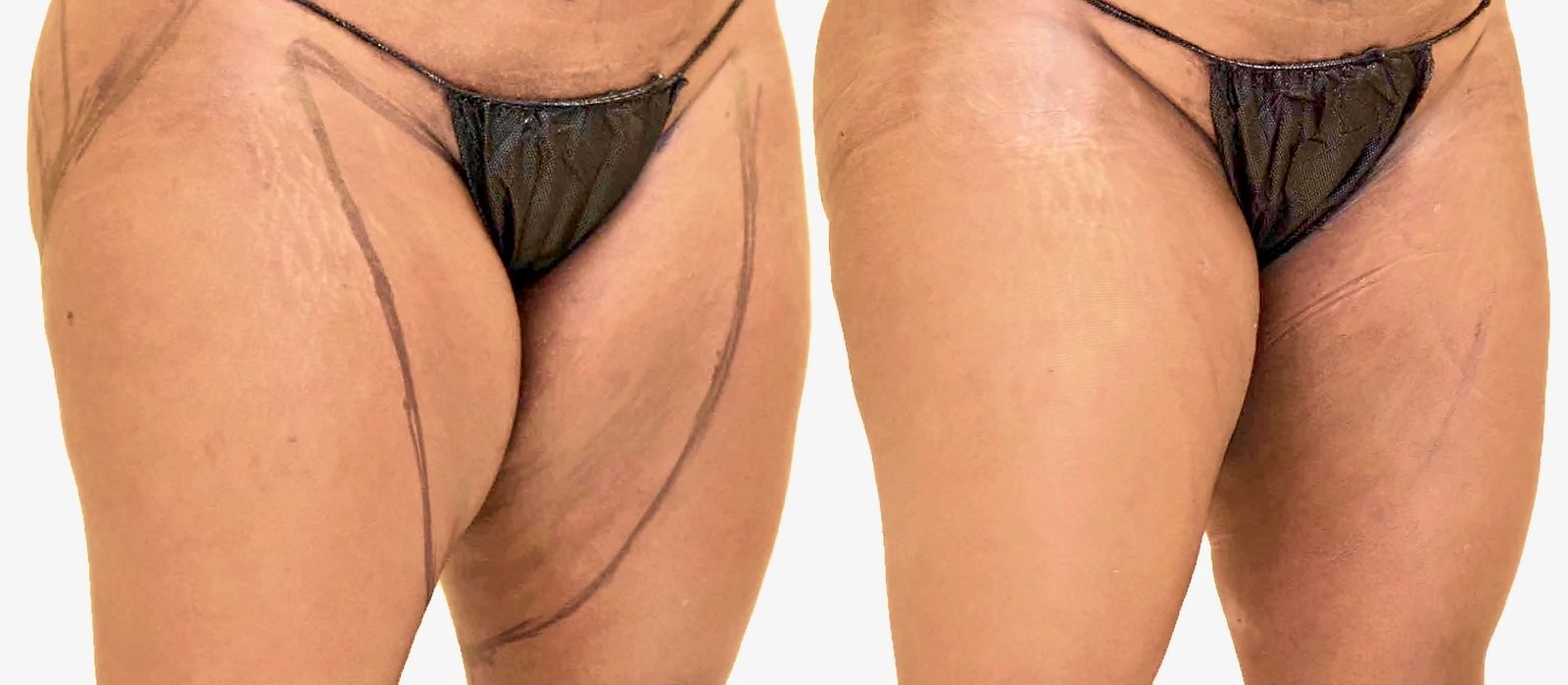 Before/After Thigh liposuction before and after, actual patient of Dr. Long