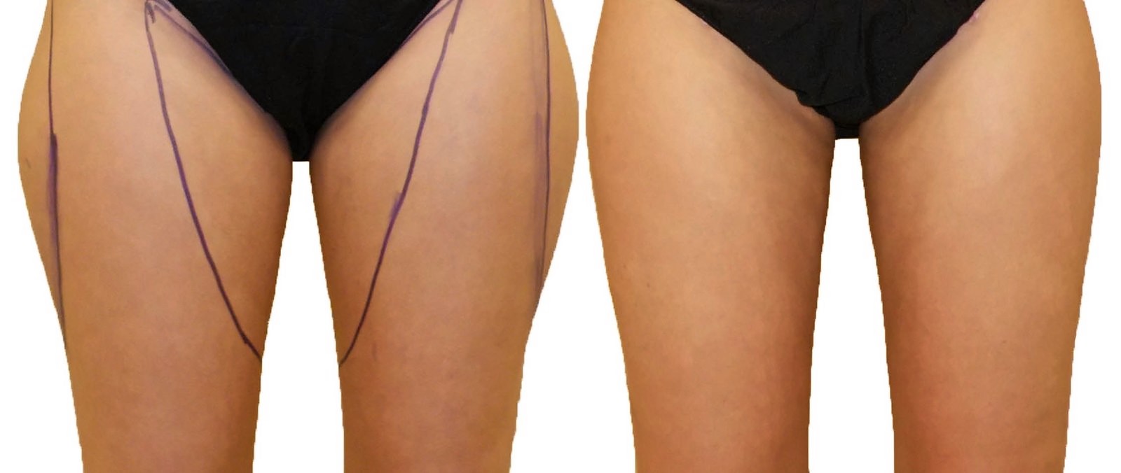 Before/After Thigh liposuction before and after, actual patient of Dr. Long