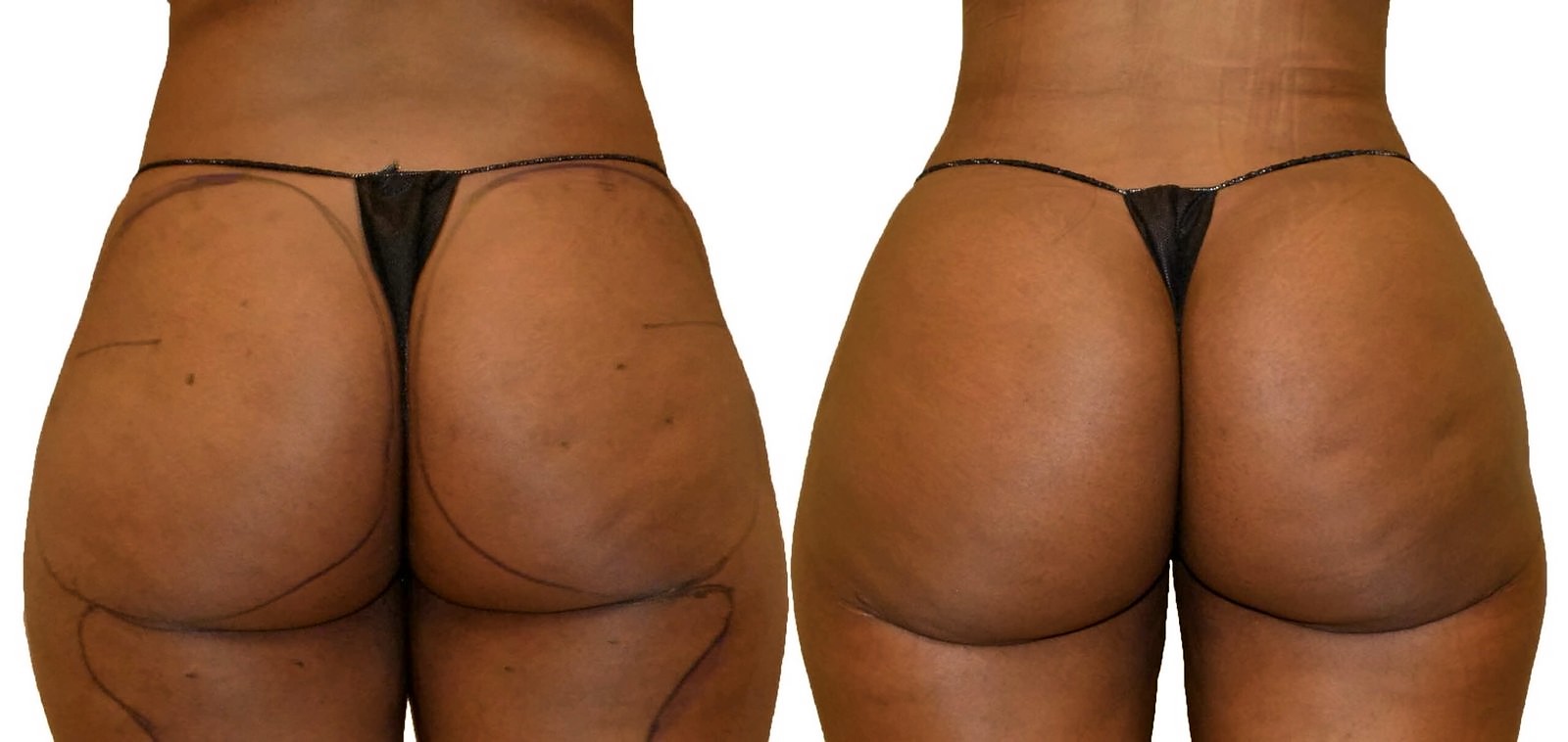 Before/After Thigh liposuction before and after, actual patient of Dr. Long