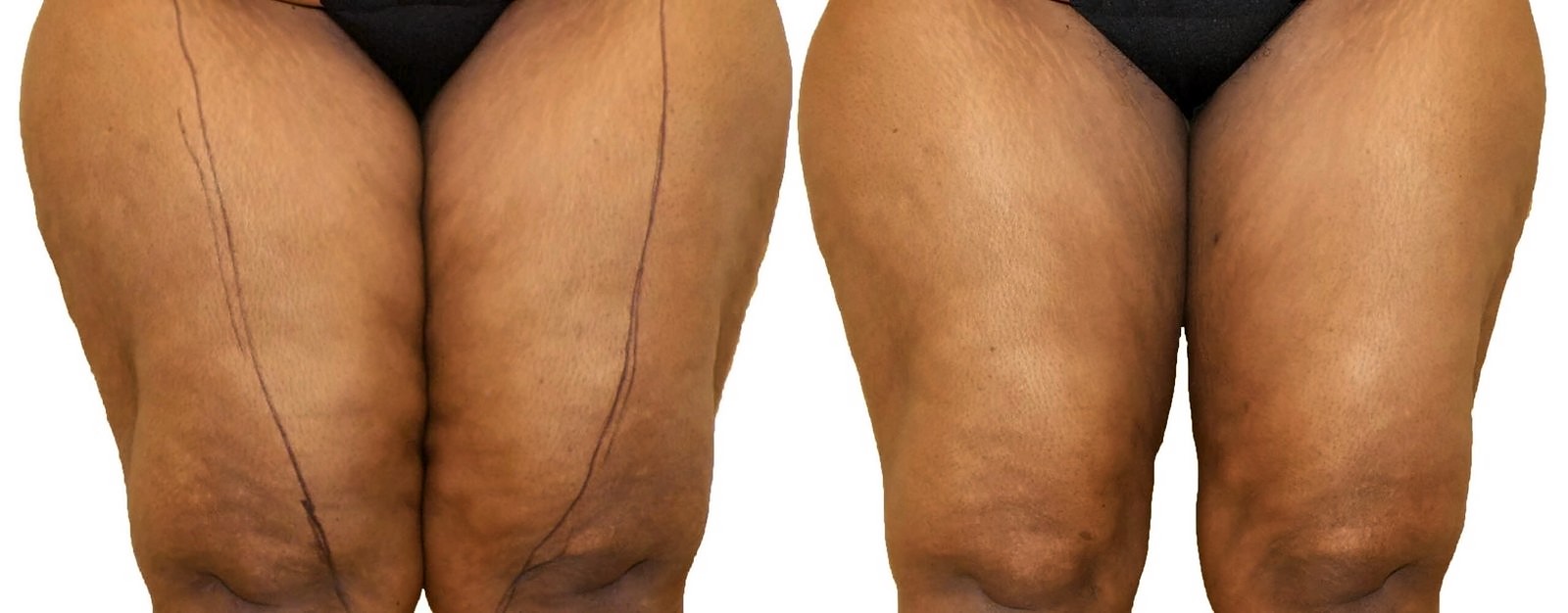 Before/After Thigh liposuction before and after, actual patient of Dr. Long