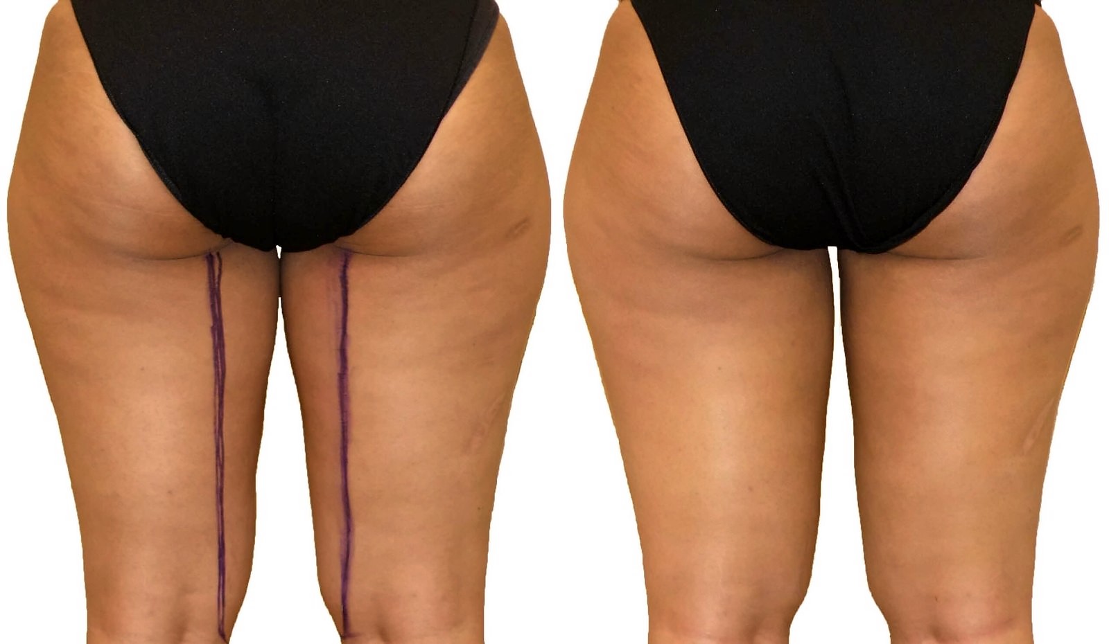 Before/After Thigh liposuction before and after, actual patient of Dr. Long