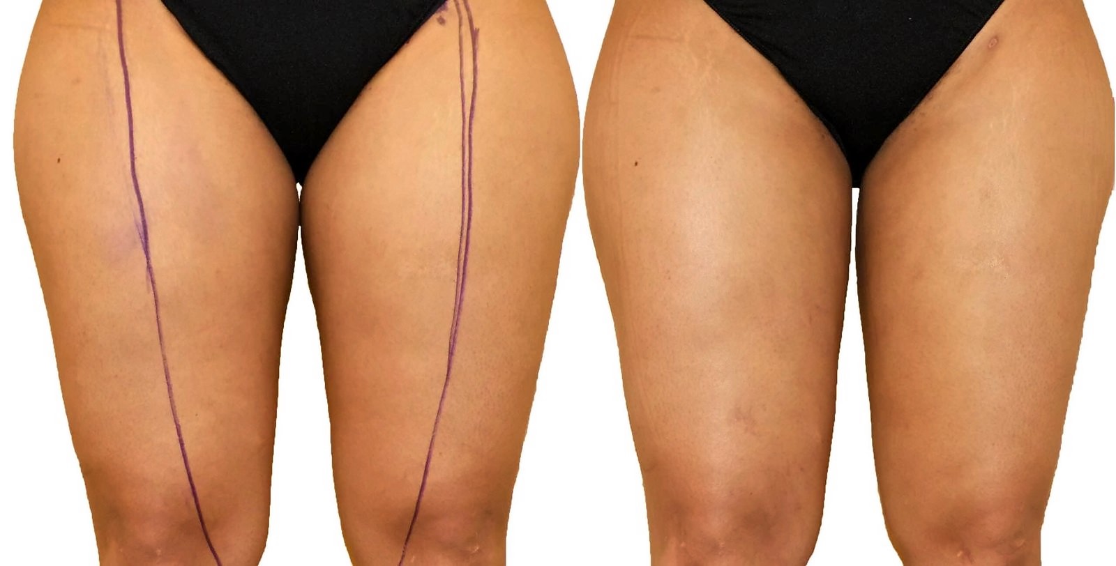 Before/After Thigh liposuction before and after, actual patient of Dr. Long