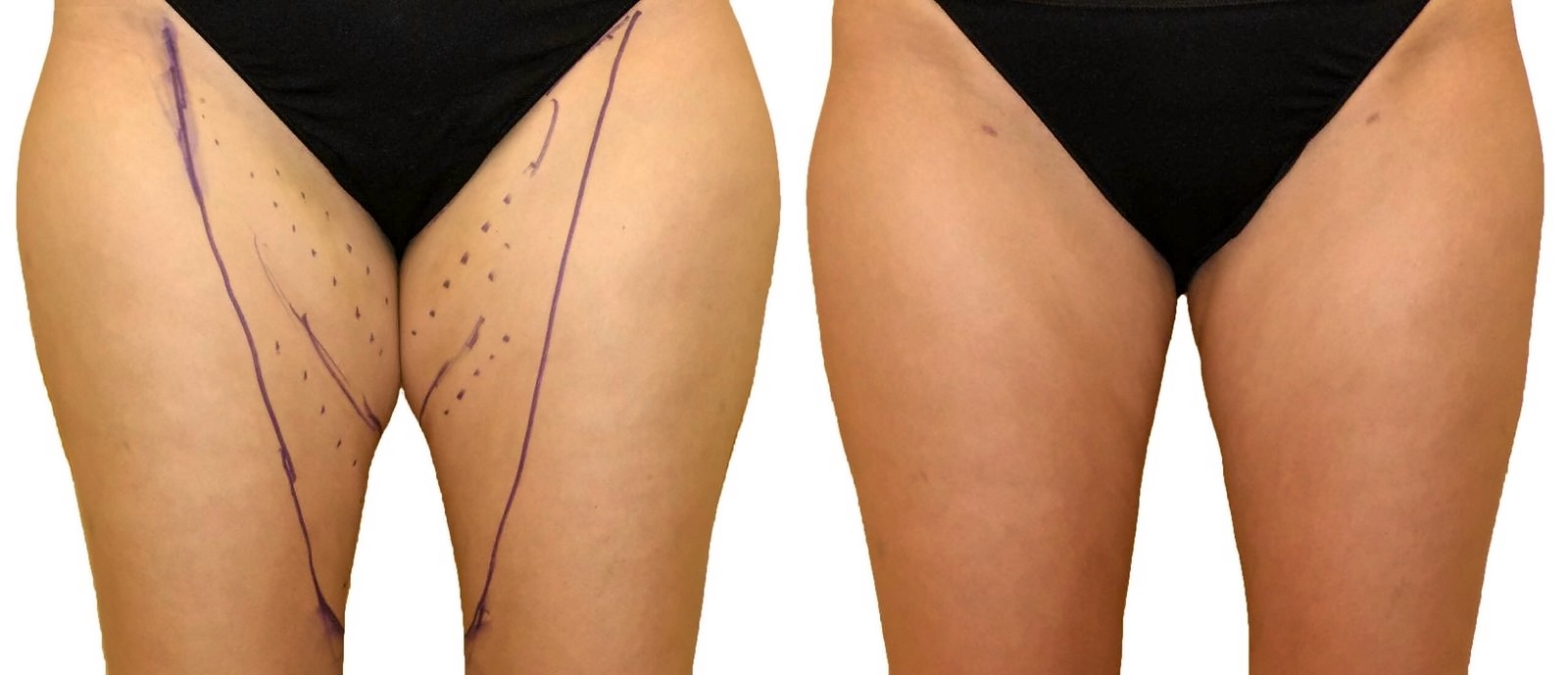Before/After Thigh liposuction before and after, actual patient of Dr. Long
