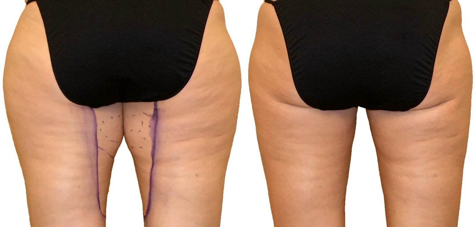 Before/After Thigh liposuction before and after, actual patient of Dr. Long