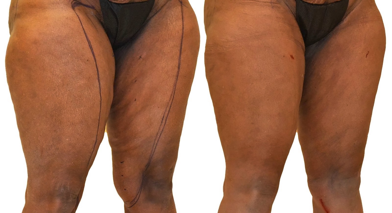 Before/After Thigh liposuction before and after, actual patient of Dr. Long
