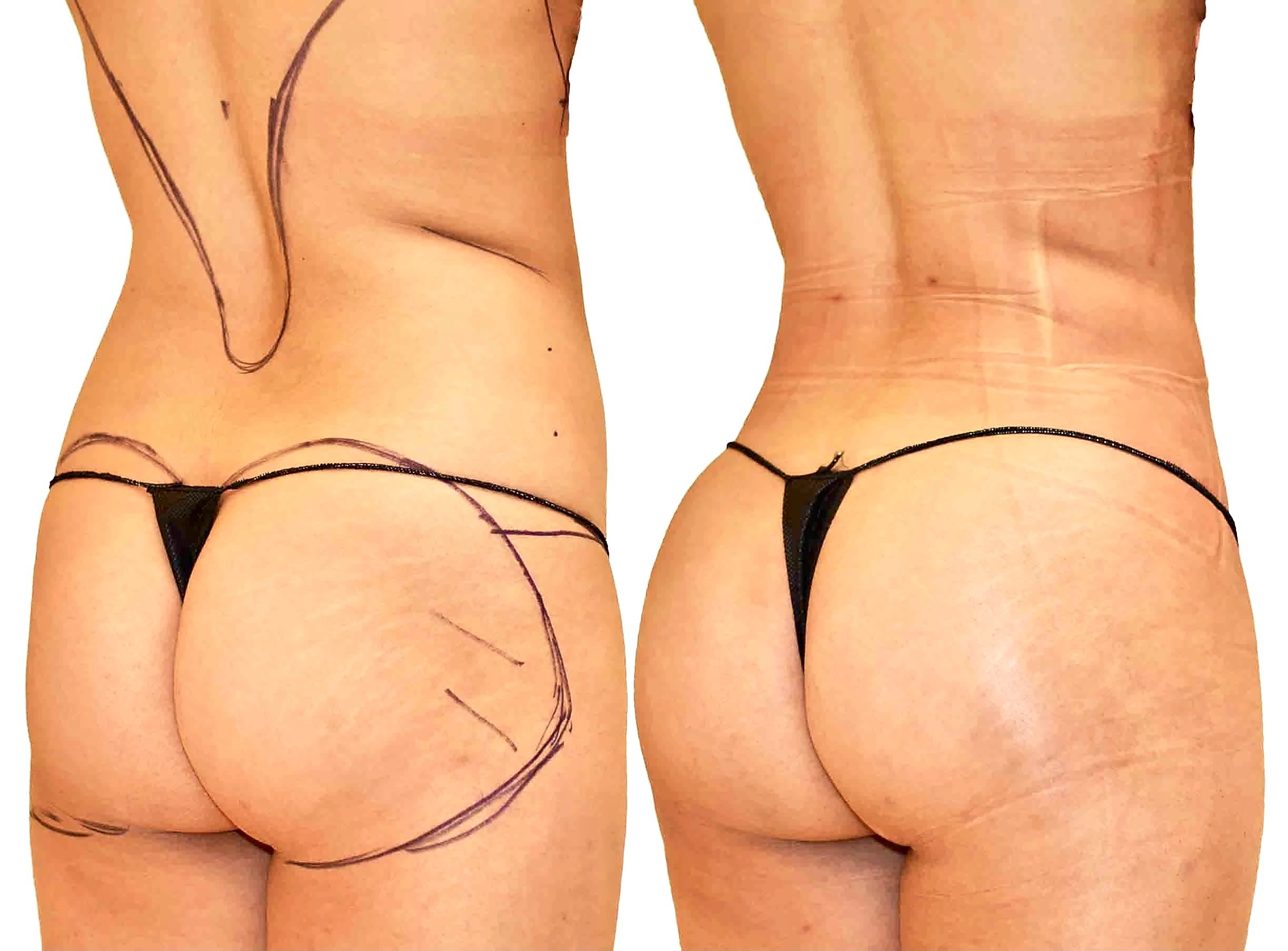 Home Fat transfer (BBL) before and after, Dr. Nathan Long, Dallas