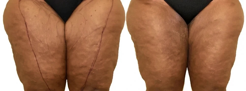 Before/After Thigh liposuction before and after, actual patient of Dr. Long