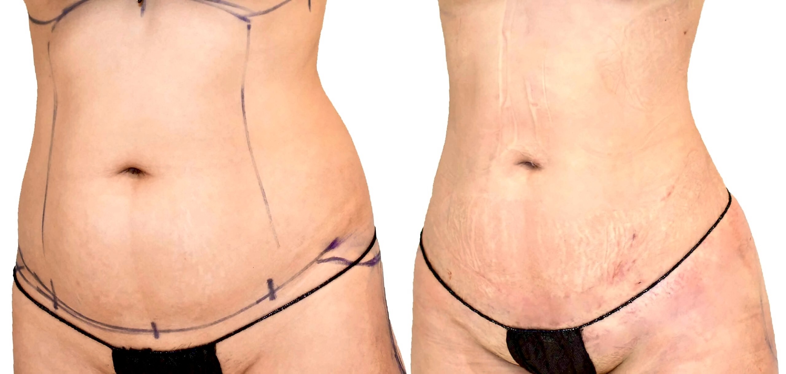 Before/After Lipo 360 before and after, actual patient of Dr. Long