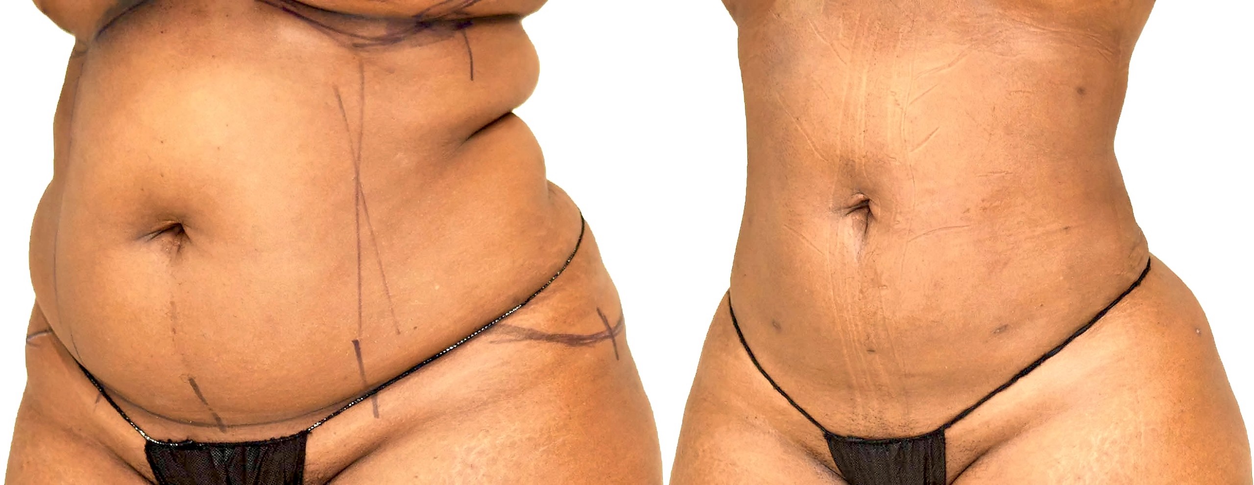 Home Lipo 360 before and after, Dr. Nathan Long, Dallas